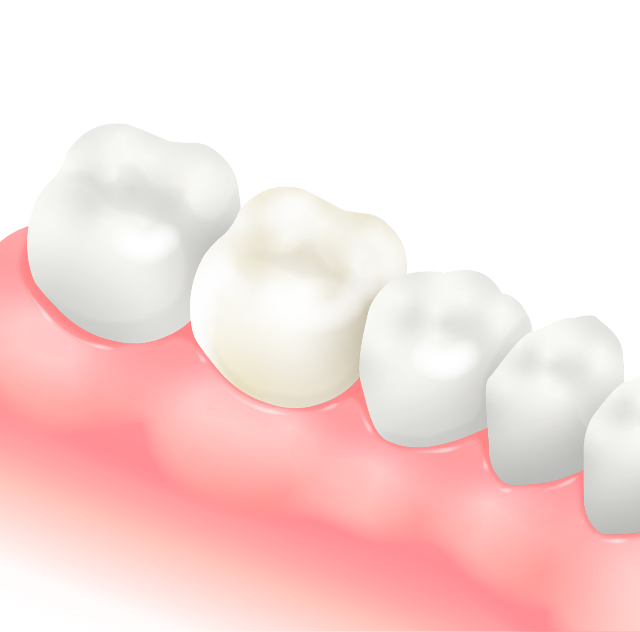 セラミッククラウン・インレー