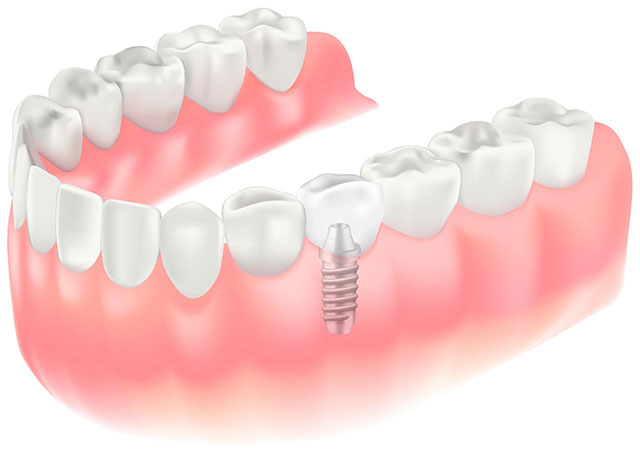 審美補綴×矯正・インプラントとの連携